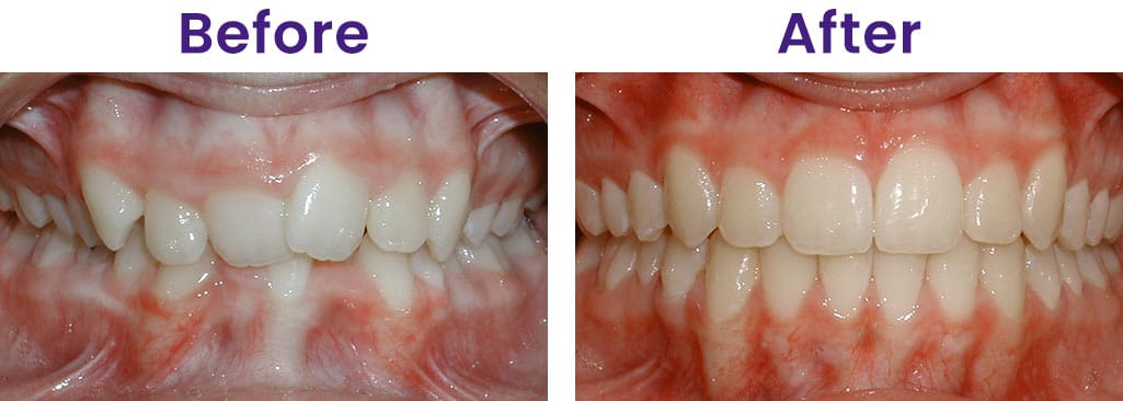 Before and After Kita Orthodontics North Little Rock Jacksonville Maumelle AR