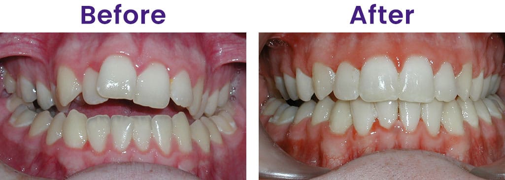 Before and After Kita Orthodontics North Little Rock Jacksonville Maumelle AR
